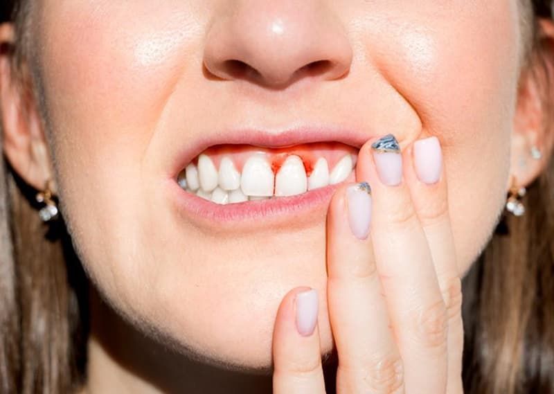 Grasp the Causes, Prevention, and Treatment of Bleeding Gums