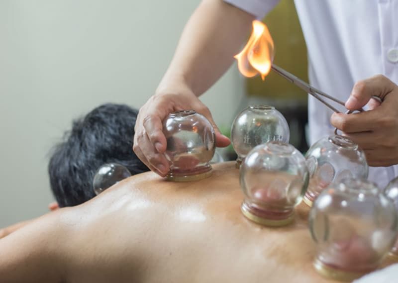 Cupping Therapy Demystified: Ancient Suction and the Evidence Behind Modern Pain Relief